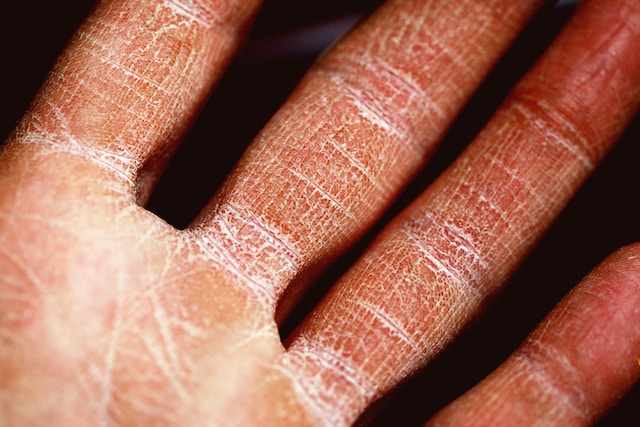 Finding Relief and Treatment for Eczema and Allergies